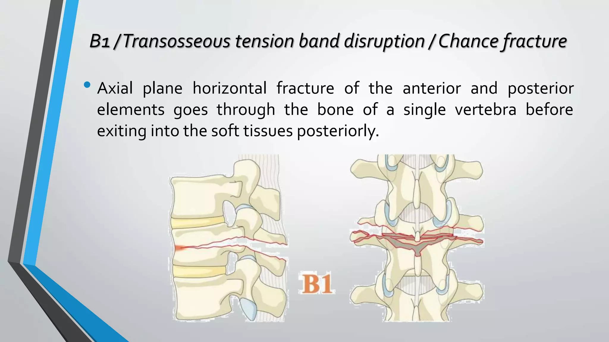 B1 /Transosseous tension band disruption / Chance fracture
• Axial plane horizontal fracture of the anterior and posterior
elements goes through the bone of a single vertebra before
exiting into the soft tissues posteriorly.
 