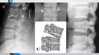 Thoracolumbar fractures classification | PPTX