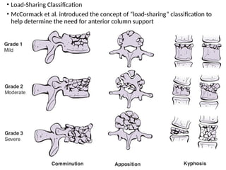 Comprehensive Overview of Thoraco-Lumbar Junction Fractures and ...