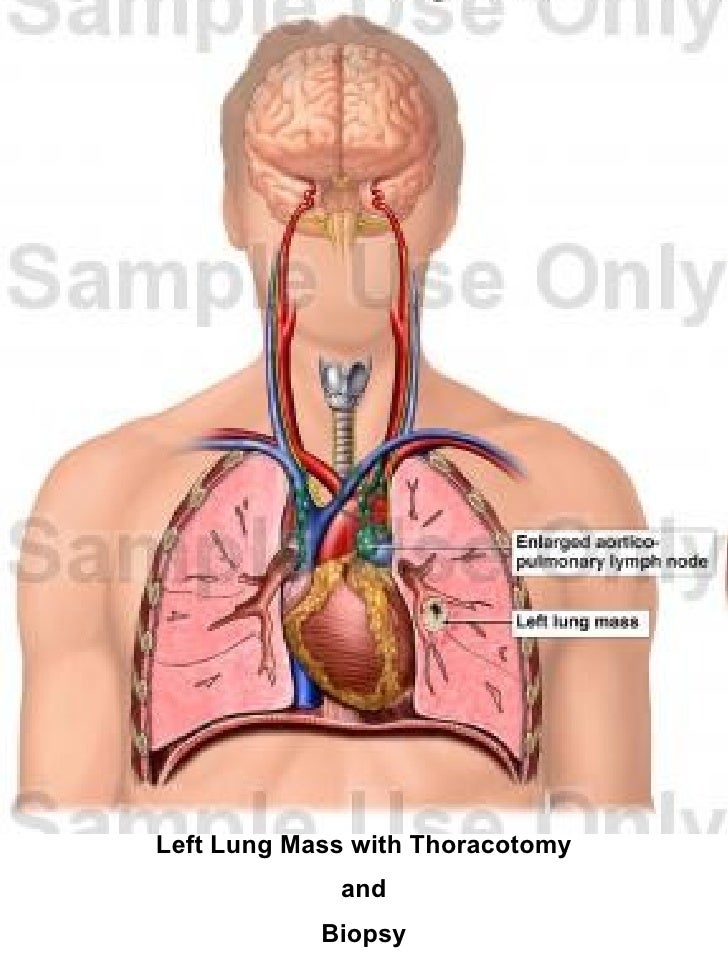 Thoracotomy