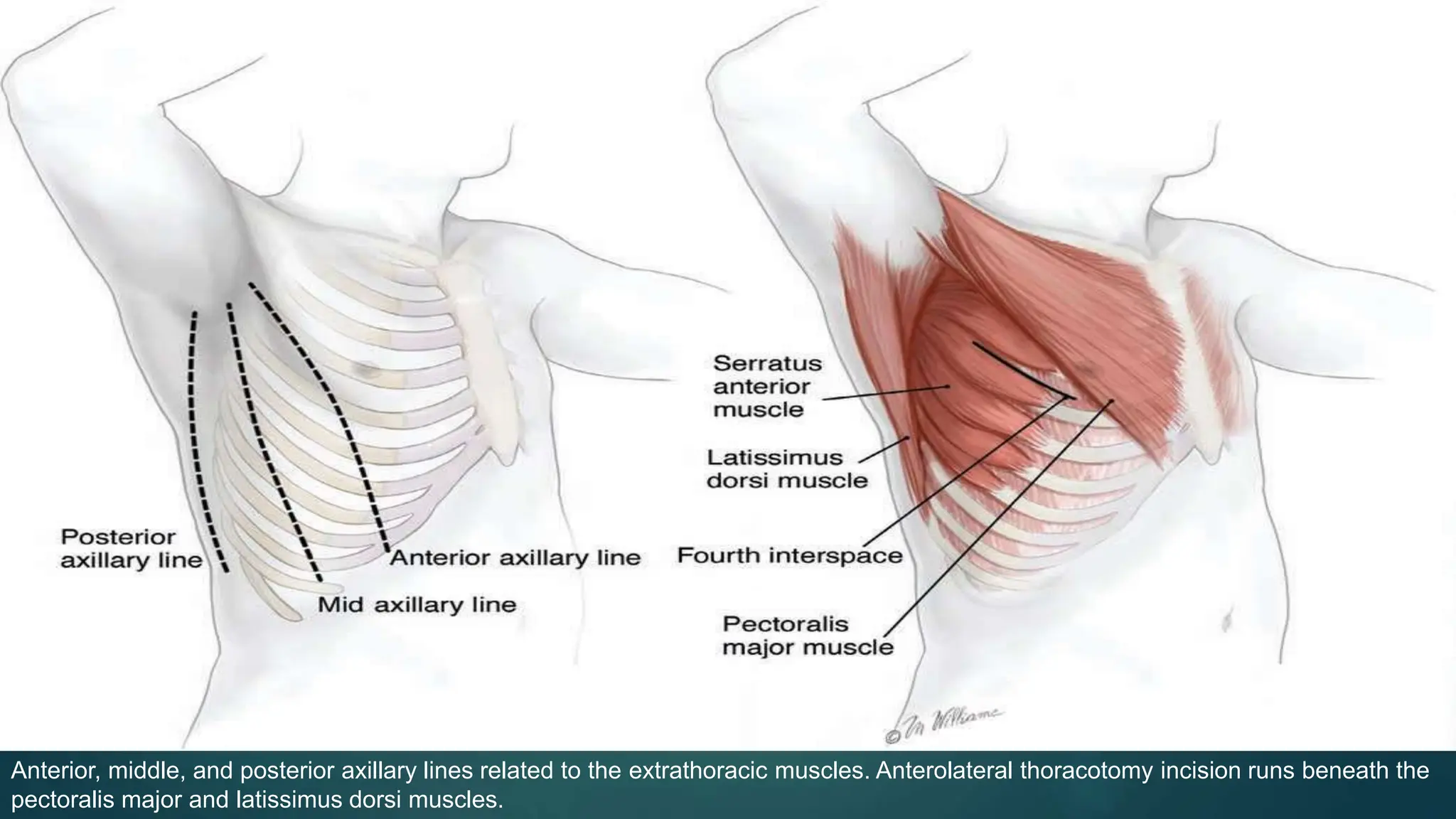 THORACOTOMY INCISION ppt by Dr. Amrit kumar | PPTX