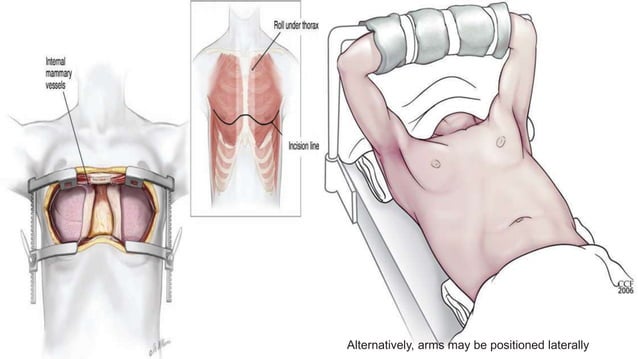 THORACOTOMY INCISION ppt by Dr. Amrit kumar | PPTX | Death, Injury, or ...