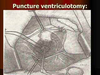 Puncture ventriculotomy:
 