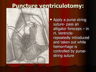 Puncture ventriculotomy:

               Apply a purse string
                suture- pass an
                alligator foreceps – in
                rt. Ventricle-
                repeatedly introduced
                and taken out while
                hemorrhage is
                controlled by purse-
                string suture
 