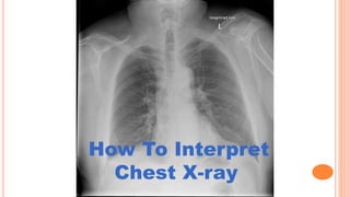 How To Interpret
Chest X-ray
 