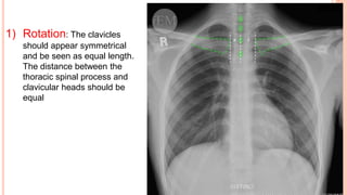 1) Rotation: The clavicles
should appear symmetrical
and be seen as equal length.
The distance between the
thoracic spinal process and
clavicular heads should be
equal
 