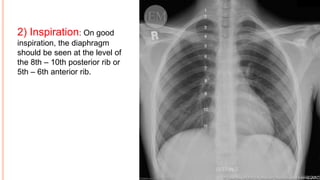 2) Inspiration: On good
inspiration, the diaphragm
should be seen at the level of
the 8th – 10th posterior rib or
5th – 6th anterior rib.
 
