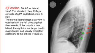 3)Position: PA, AP, or lateral
view? The standard chest X-Rays
consists of a PA and lateral chest X-
Ray.
The normal lateral chest x-ray view is
obtained with the left chest against
the cassette. If the x-ray is a true
lateral, the right ribs are larger due to
magnification and usually projected
posteriorly to the left ribs (Figure-3).
 