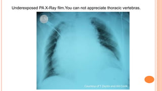 Underexposed PA X-Ray film.You can not appreciate thoracic vertebras.
 