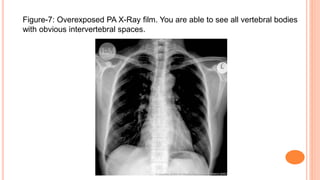 Figure-7: Overexposed PA X-Ray film. You are able to see all vertebral bodies
with obvious intervertebral spaces.
 