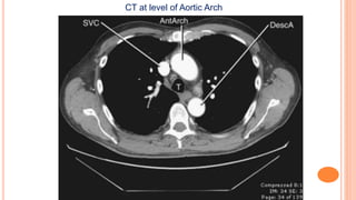 CT at level of Aortic Arch
 