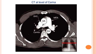 CT at level of Carina
 