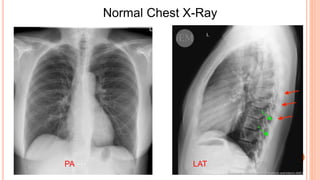 Normal Chest X-Ray
PA LAT
 