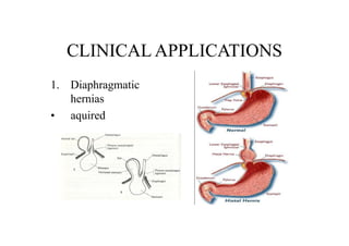 CLINICAL APPLICATIONS
1. Diaphragmatic
hernias
• aquired
 