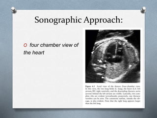 Sonographic Approach:
O four chamber view of
the heart
 
