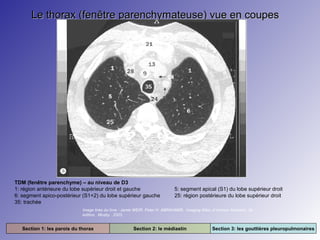 Le thorax (fenêtre parenchymateuse) vue en coupes

TDM (fenêtre parenchyme) – au niveau de D3
1: région antérieure du lobe supérieur droit et gauche
6: segment apico-postérieur (S1+2) du lobe supérieur gauche
35: trachée

5: segment apical (S1) du lobe supérieur droit
25: région postérieure du lobe supérieur droit

Image tirée du livre : Jamie WEIR. Peter H. ABRAHAMS. Imaging Atlas of Human Anatomy. 3e
édition. Mosby. 2003.

Section 1: les parois du thorax

Section 2: le médiastin

Section 3: les gouttières pleuropulmonaires

 