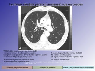 Le thorax (fenêtre parenchymateuse) vue en coupes

TDM (fenêtre parenchyme) – au niveau de D6
1: région antérieure du lobe supérieur gauche
6: segment apico-postérieur (S1+2) du lobe supérieur gauche
23: scissure oblique du poumon gauche

4: segment apical du lobe inférieur droit (S6)
16: bronche souche gauche
25: région postérieure du lobe supérieur droit

26: bronche segmentaire postérieure droite
29: bronche souche droite
30: bronche lobaire supérieure droite du livre : Jamie WEIR. Peter H. ABRAHAMS. Imaging Atlas of Human Anatomy. 3e
Image tirée
édition. Mosby. 2003.

Section 1: les parois du thorax

Section 2: le médiastin

Section 3: les gouttières pleuro-pulmonaires

 