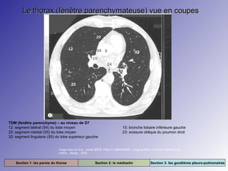 Le thorax (fenêtre parenchymateuse) vue en coupes

TDM (fenêtre parenchyme) – au niveau de D7
12: segment latéral (S4) du lobe moyen
22: segment médial (S5) du lobe moyen
32: segment lingulaire (S5) du lobe supérieur gauche

15: bronche lobaire inférieure gauche
23: scissure oblique du poumon droit

Image tirée du livre : Jamie WEIR. Peter H. ABRAHAMS. Imaging Atlas of Human Anatomy. 3e
édition. Mosby. 2003.

Section 1: les parois du thorax

Section 2: le médiastin

Section 3: les gouttières pleuro-pulmonaires

 
