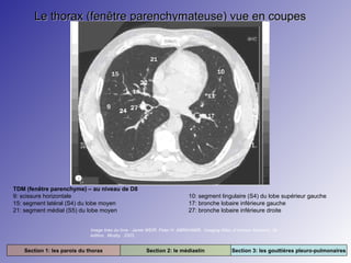 Le thorax (fenêtre parenchymateuse) vue en coupes

TDM (fenêtre parenchyme) – au niveau de D8
9: scissure horizontale
15: segment latéral (S4) du lobe moyen
21: segment médial (S5) du lobe moyen

10: segment lingulaire (S4) du lobe supérieur gauche
17: bronche lobaire inférieure gauche
27: bronche lobaire inférieure droite

Image tirée du livre : Jamie WEIR. Peter H. ABRAHAMS. Imaging Atlas of Human Anatomy. 3e
édition. Mosby. 2003.

Section 1: les parois du thorax

Section 2: le médiastin

Section 3: les gouttières pleuro-pulmonaires

 