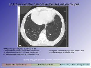Le thorax (fenêtre parenchymateuse) vue en coupes

TDM (fenêtre parenchyme) – au niveau de D9
1: segment basal antérieur (S8) du lobe inférieur droit
19: segment baso-médial (S7) du lobe inférieur droit
25: segment baso-dorsal (S10) du lobe inférieur droit

13: segment baso-latéral (S9) du lobe inférieur droit
24: scissure oblique du poumon droit

Image tirée du livre : Jamie WEIR. Peter H. ABRAHAMS. Imaging Atlas of Human Anatomy. 3e
édition. Mosby. 2003.

Section 1: les parois du thorax

Section 2: le médiastin

Section 3: les gouttières pleuro-pulmonaires

 
