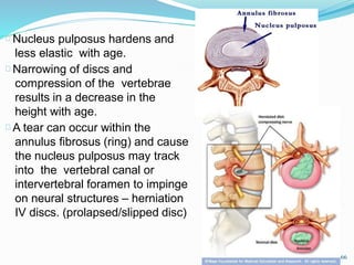 Nucleus pulposus hardens and
less elastic with age.
Narrowing of discs and
compression of the vertebrae
results in a decrease in the
height with age.
A tear can occur within the
annulus fibrosus (ring) and cause
the nucleus pulposus may track
into the vertebral canal or
intervertebral foramen to impinge
on neural structures – herniation
IV discs. (prolapsed/slipped disc)
66
 