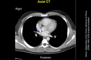 Thorax and Abdomen CT Cheat Sheet | PDF