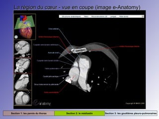 La région du cœur - vue en coupe (image e-Anatomy)La région du cœur - vue en coupe (image e-Anatomy)
Section 1: les parois du thorax Section 2: le médiastin Section 3: les gouttières pleuro-pulmonaires
 