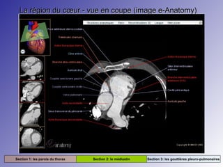 La région du cœur - vue en coupe (image e-Anatomy)La région du cœur - vue en coupe (image e-Anatomy)
Section 1: les parois du thorax Section 2: le médiastin Section 3: les gouttières pleuro-pulmonaires
 
