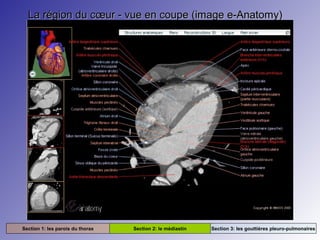 La région du cœur - vue en coupe (image e-Anatomy)La région du cœur - vue en coupe (image e-Anatomy)
Section 1: les parois du thorax Section 2: le médiastin Section 3: les gouttières pleuro-pulmonaires
 