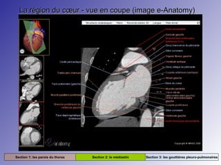 La région du cœur - vue en coupe (image e-Anatomy)La région du cœur - vue en coupe (image e-Anatomy)
Section 1: les parois du thorax Section 2: le médiastin Section 3: les gouttières pleuro-pulmonaires
 