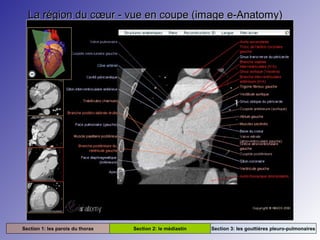 La région du cœur - vue en coupe (image e-Anatomy)La région du cœur - vue en coupe (image e-Anatomy)
Section 1: les parois du thorax Section 2: le médiastin Section 3: les gouttières pleuro-pulmonaires
 