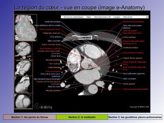 La région du cœur - vue en coupe (image e-Anatomy)La région du cœur - vue en coupe (image e-Anatomy)
Section 1: les parois du thorax Section 2: le médiastin Section 3: les gouttières pleuro-pulmonaires
 