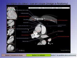 La région du cœur - vue en coupe (image e-Anatomy)La région du cœur - vue en coupe (image e-Anatomy)
Section 1: les parois du thorax Section 2: le médiastin Section 3: les gouttières pleuro-pulmonaires
 