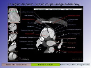 La région du cœur - vue en coupe (image e-Anatomy)La région du cœur - vue en coupe (image e-Anatomy)
Section 1: les parois du thorax Section 2: le médiastin Section 3: les gouttières pleuro-pulmonaires
 