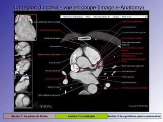 La région du cœur - vue en coupe (image e-Anatomy)La région du cœur - vue en coupe (image e-Anatomy)
Section 1: les parois du thorax Section 2: le médiastin Section 3: les gouttières pleuro-pulmonaires
 