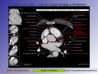 La région du cœur - vue en coupe (image e-Anatomy)La région du cœur - vue en coupe (image e-Anatomy)
Section 1: les parois du thorax Section 2: le médiastin Section 3: les gouttières pleuro-pulmonaires
 