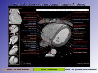 La région du cœur - vue en coupe (image e-Anatomy)La région du cœur - vue en coupe (image e-Anatomy)
Section 1: les parois du thorax Section 2: le médiastin Section 3: les gouttières pleuro-pulmonaires
 