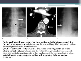 Tangential Radiograph thorax med.pptx
