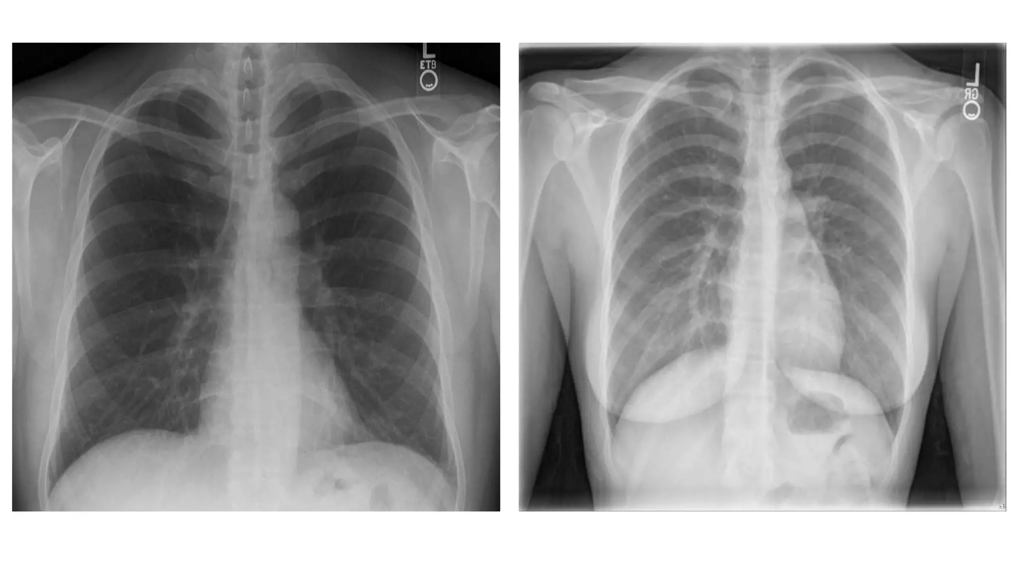 Human Thoracci Radiograph Thorax radiology | PPTX