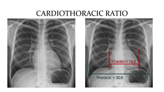 CARDIOTHORACIC RATIO
 