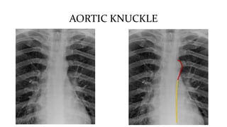 AORTIC KNUCKLE
 