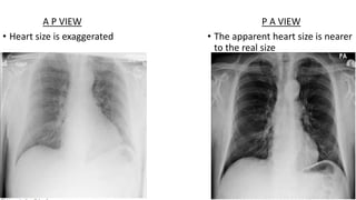 A P VIEW
• Heart size is exaggerated
P A VIEW
• The apparent heart size is nearer
to the real size
 