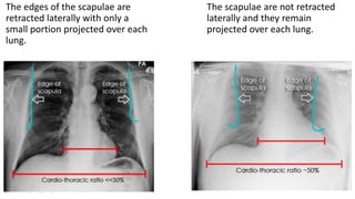 The edges of the scapulae are
retracted laterally with only a
small portion projected over each
lung.
The scapulae are not retracted
laterally and they remain
projected over each lung.
 