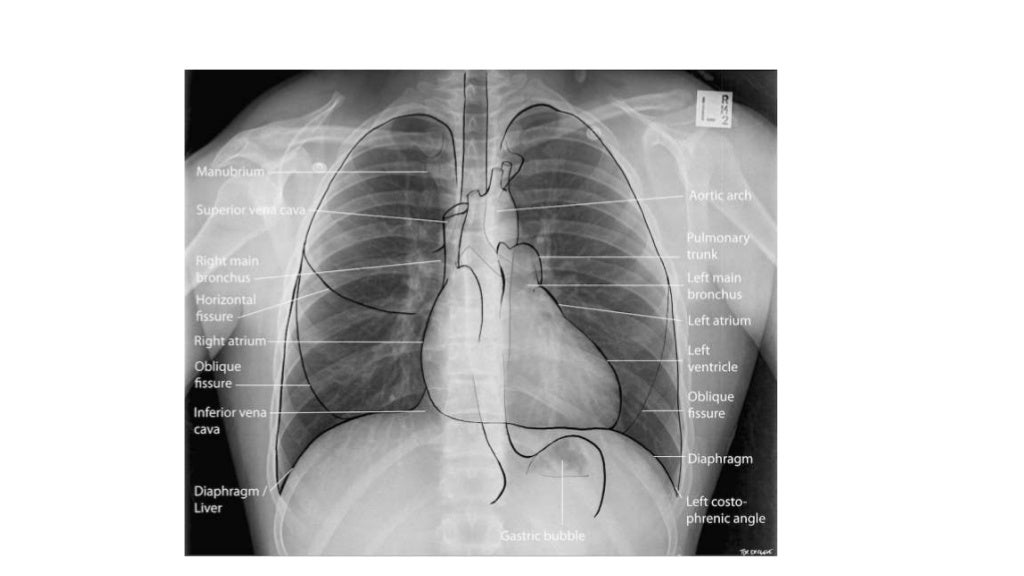 Thorax radiology