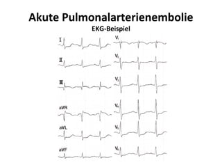 Akute Pulmonalarterienembolie
           EKG-Beispiel
 