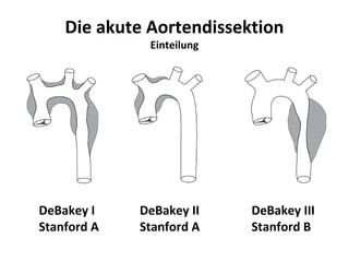 Die akute Aortendissektion
              Einteilung




DeBakey I    DeBakey II    DeBakey III
Stanford A   Stanford A    Stanford B
 