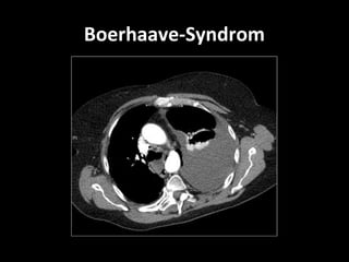 Boerhaave-Syndrom
 