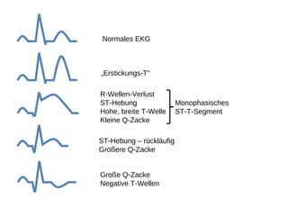 Normales EKG



„Erstickungs-T“

R-Wellen-Verlust
ST-Hebung                Monophasisches
Hohe, breite T-Welle     ST-T-Segment
Kleine Q-Zacke

ST-Hebung – rückläufig
Größere Q-Zacke


Große Q-Zacke
Negative T-Wellen
 