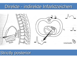 Direkte - indirekte Infarktzeichen




Strictly posterior
 