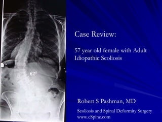 Case Review:
      57 year old female with Adult
      Idiopathic Scoliosis

62°




       Robert S Pashman, MD
       Scoliosis and Spinal Deformity Surgery
       www.eSpine.com
 